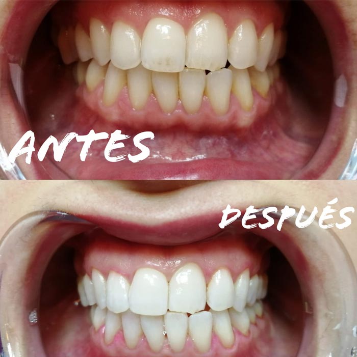 Humanes Dental blanqueamiento dental antes y después