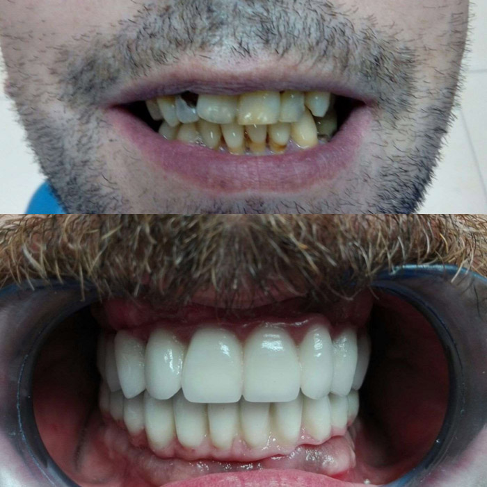 Humanes Dental tratamiento dental antes y después