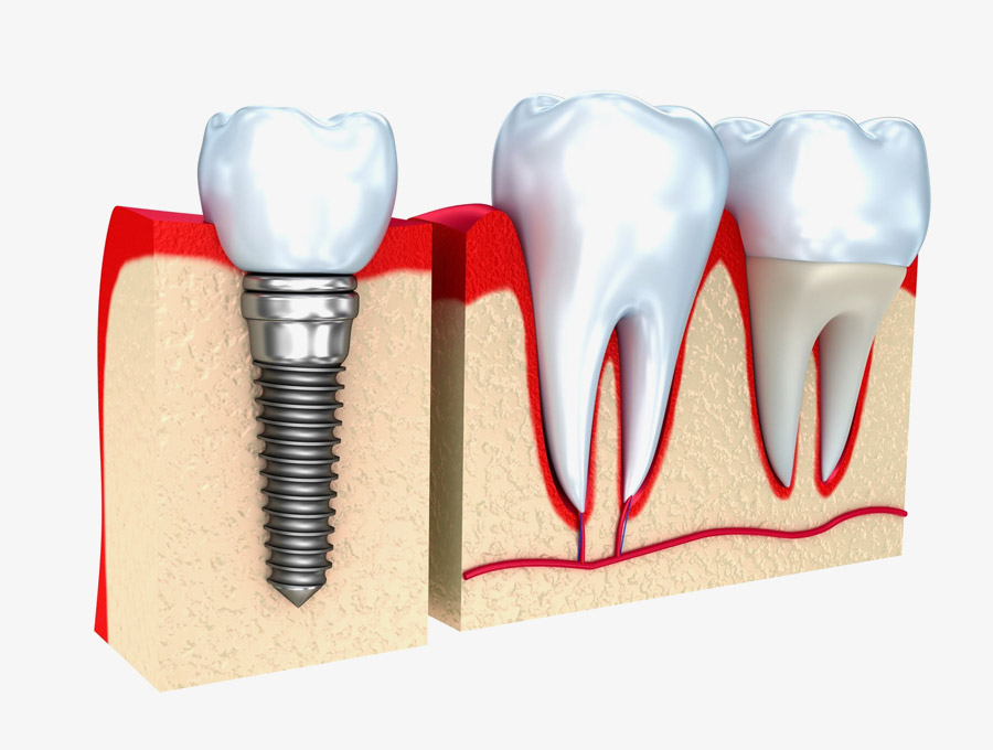 Humanes Dental implantes dentales